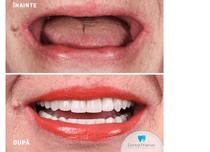 Ce presupune o coroană pe implant dentar: cum este abordat tratamentul la Dental Premier din București?