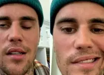 Justin Bieber suferă de paralizie facială cauzată de sindromul Ramsay Hunt. Artistul și-a anulat concertele