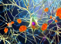 13 vedete cu afecțiuni neurodegenerative