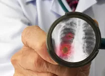 6 cauze comune ale pneumoniei
