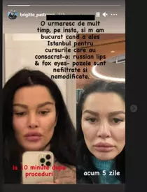 Brigitte-operatii-estetice