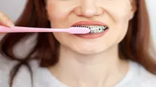 Cum se îngrijește aparatul dentar: Reguli de igienă