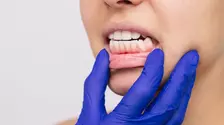 Problema dentară ascunsă care îți distruge dinții și provoacă dureri de cap. Ce este mușcătura inversă și cum o tratezi la timp