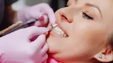 Albire, fațete sau coroane dentare: ce rezolvă fiecare