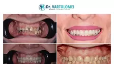 Zâmbet natural și estetica dentară responsabilă: ce trebuie să știi înainte de fațete dentare