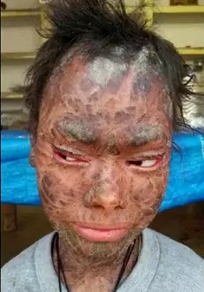 O tânără trece prin probleme grave cu pielea sa