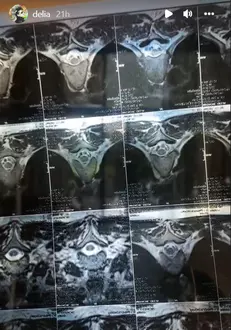 Delia are probleme cu coloana vertebrala