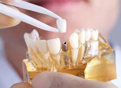 (P) Cum se inseră implantul dentar