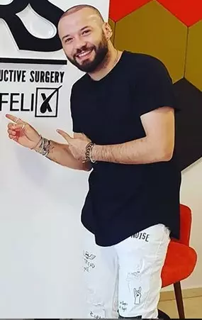 Bogdan, după implantul de păr.