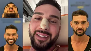 Cum arată Dorian Popa după operația la nas. Vloggerul și-a dat jos bandajele: „Exact ce îmi doream!”