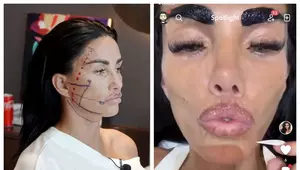Katie Price, de nerecunoscut după cea mai recentă intervenție la nivelul feței. "Buzele mele par atât de subțiri, urăsc asta!"