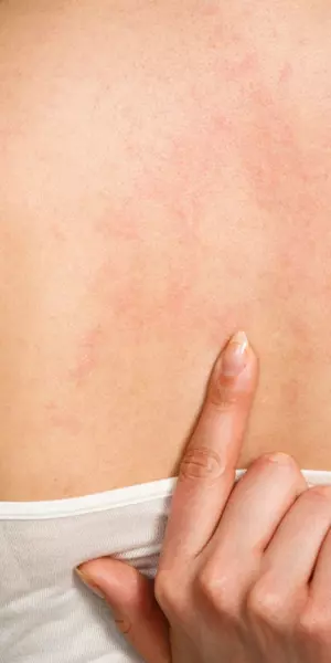 Boli De Piele Cum Le RecunoÈti Pe Cele Mai Importante Foto Boli Si Tratamente SÄnÄtate Unica Ro