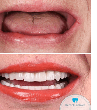 Ce presupune o coroană pe implant dentar: cum este abordat tratamentul la Dental Premier din București?