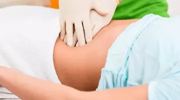 Simptomul observat prima dată de o pacientă care a supraviețuit cancerului de colon