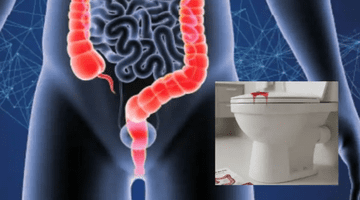 Cancerul colorectal poate evolua în tăcere. 7 semne care ar trebui să te trimită la medic