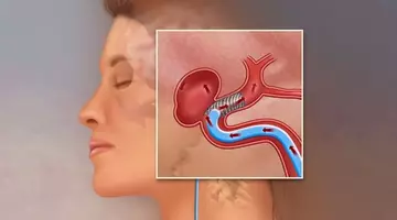 Semnalul tăcut al anevrismului cerebral care poate ucide pe loc. Milioane de oameni îl ignoră zilnic