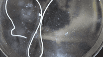 Româncă din Franța, operată de urgență după ce medicii au găsit un vierme de 11 cm în cap. Sunt tot mai multe cazuri în Europa