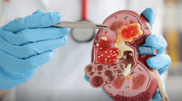 REMEDII NATURALE. TOP 5 alimente care ajută rinichii să filtreze eficient toxinele