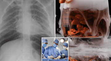 Medic avertizează: ingredientul „spectaculos” din unele băuturi care îți poate perfora stomacul