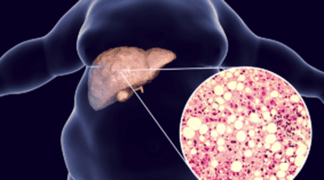 Alimentele care reduc inflamația și ajută la eliminarea grăsimii din ficat, recomandate de un gastroenterolog