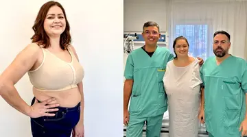 Cazul impresionant al femeii care suferea de gigantomastie. Cum a ajuns de la cupa F la cupa C. „Sânii imenși deveniseră o povară!”