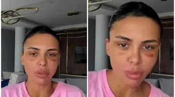Ce operații estetice și-a făcut Andreea Popescu după divorțul de Rareș Cojoc! „Mi-a căzut părul enorm”. Fanii nu o mai recunosc!