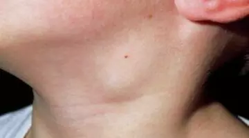 De ce să mergi neapărat la medic dacă ai un ganglion mărit. Atenționarea unui medic infecționist