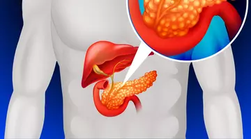 Cancerul de pancreas, oprit din evoluție. Leziunile precanceroase ar putea fi împiedicate să formeze o tumoră agresivă