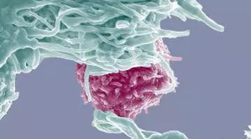 Diagnostic ratat ani la rând. O femeie a aflat că are cancer de col uterin în stadiu avansat după nenumărate vizite la medic