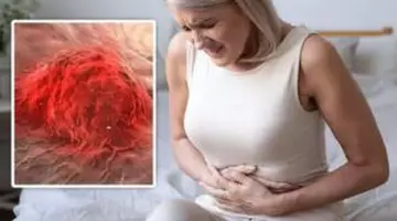 Impresionant! Ce s-a găsit în intestinul pacienților cu cancer