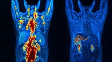 Un pacient cu cancer a intrat în remisie completă în 48 de zile. Terapia care i-a schimbat viața