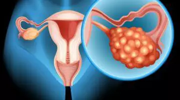 Amorțeala mâinilor și picioarelor, singurul simptom de cancer ovarian în cazul unei femei. „Nu era normal și știam asta”