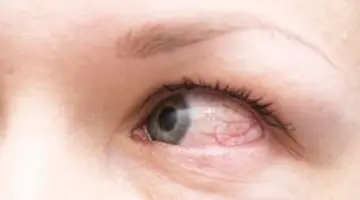 Acest simptom ocular poate anunța un AVC. Cum îl recunoști la timp