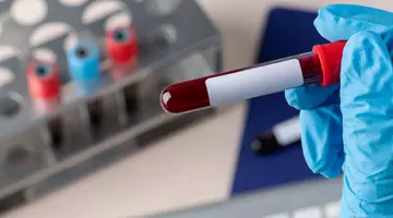 Testul de sânge care a depistat aproape 9 din 10 cancere pancreatice aflate în stadii timpurii