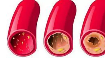 Băutura simplă de dimineață care poate reduce colesterolul „rău”. Nutriționiștii explică de ce funcționează