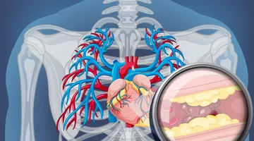 Colesterolul poate părea normal, dar riscul de infarct să fie ascuns în altă analiză pe care puțini o fac