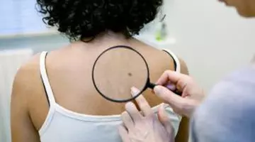 10 semne de cancer de piele pe care mulți oameni le ignoră. Nu doar alunițele pot ascunde boala