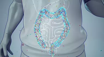 Cancerul de colon nu a revenit la niciunul dintre cei 32 de pacienți, după aproape 3 ani. Terapia administrată timp de doar 9 săptămâni