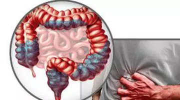 Medic gastroenterolog: „Așa îți protejezi colonul”. Dieta simplă care poate reduce riscul de cancer