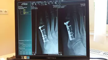 Un os rupt, după 50 de ani, poate fi primul semn de cancer avansat