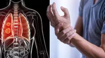 Primele semne ale cancerului pulmonar apar chiar la mâini. Nu le ignora!
