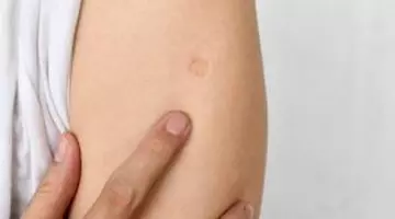 De ce au milioane de oameni aceeași cicatrice pe braț. Ce au în comun cei care poartă acest semn