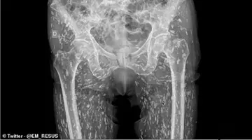 Bărbat infestat cu larve de tenie în tot corpul de la carnea de porc