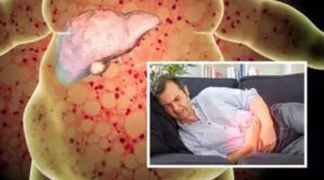 Ficatul gras sever: două medicamente pot opri și repara leziunile hepatice