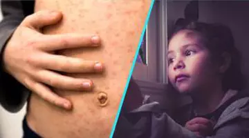 Alertă pe un zbor internațional: doi pasageri cu rujeolă au aterizat la destinație. Autoritățile caută persoanele expuse