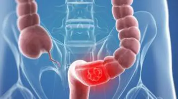 Alimentul pe care oncologii recomandă să-l mănânci cât mai rar. Doar 50 de grame pe zi, asociate cu un risc mai mare de cancer de colon