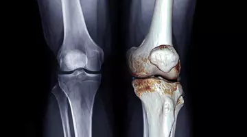 Cele mai bune tratamente pentru artroză nu sunt pastilele. Ce funcționează cu adevărat pentru durerea de genunchi – Studiu