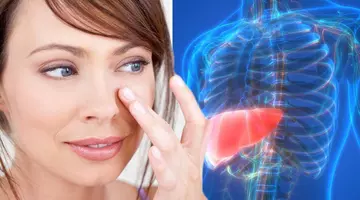 Dacă ochii tăi arată așa, ficatul tău are probleme. Nu ignora ACESTE 6 semne neobișnuite