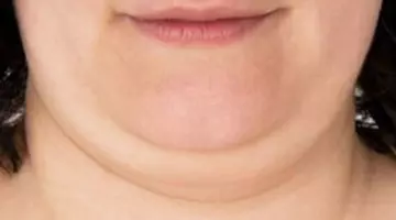 Vitamina despre care se spune că poate topi gușa în doar câteva săptămâni