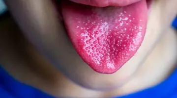 Semnul care apare pe limbă și poate indica lipsa unor vitamine. Medicii spun când este cazul să mergi la analize